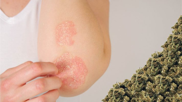 Cbd Para Psoriasis